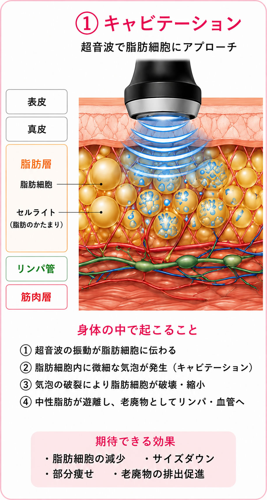 キャビテーション図解画像